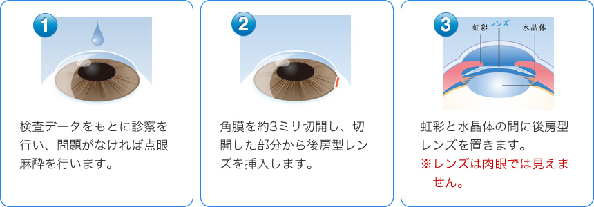 レーシック ICL 分割払い